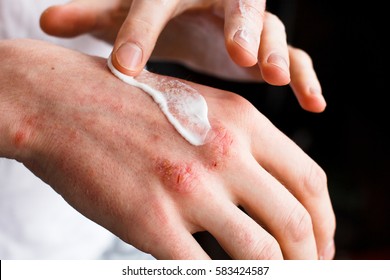Dermatologist doctor doing treatment, male patient with allergic rash dermatitis eczema skin, Skin diseases.