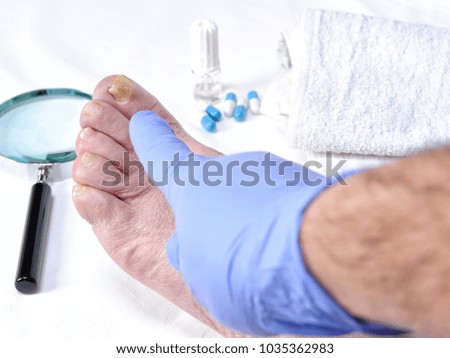 Dermatologist doctor visits the nails of a patient affected by onychomycosis following the action of pathogenic fungi.