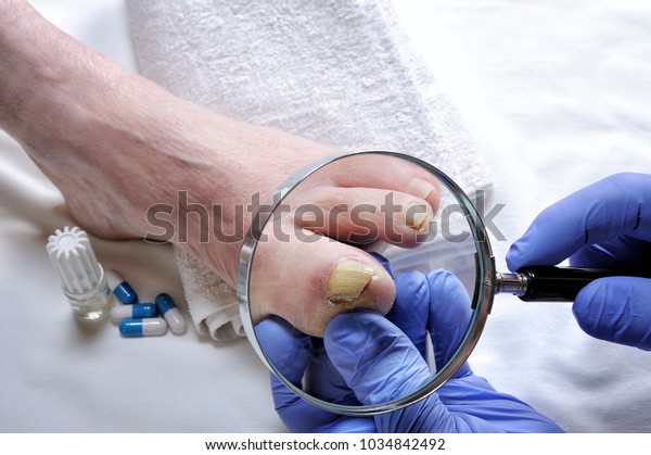 Dermatologist\
doctor visits the nails of a patient affected by onychomycosis\
following the action of pathogenic\
fungi.