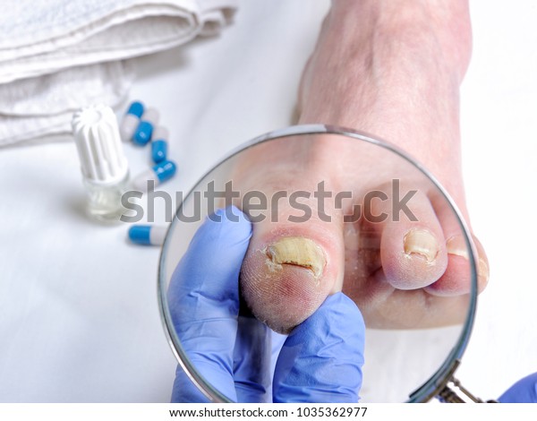 Dermatologist\
doctor visits the nails of a patient affected by onychomycosis\
following the action of pathogenic\
fungi.
