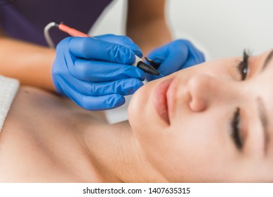 Dermatologist Doing Hair Removal Treatment On Patient's Face With Electrolysis