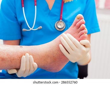 Dermatologist examining elderly patient's arteriosclerotic, dry leg with severe nail fungus.