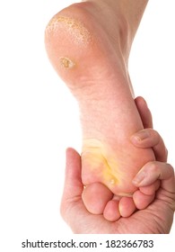 Dermatologist Examining A Foot For Callus And Dry Skin, Towards White