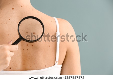 Dermatologist examining moles of patient on grey background