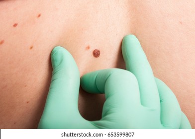 Dermatologist Hand Inspecting Skin Mole As Epidermal Cancer Suspect Concept