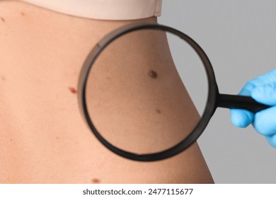 Dermatologist with magnifier examining moles on woman's back against grey background, closeup