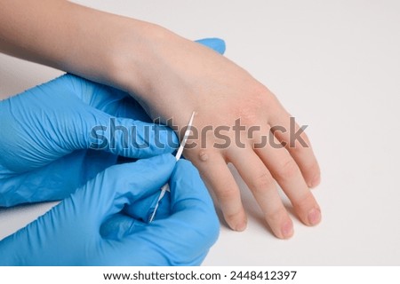  Dermatologist in medical gloves treats a child hand affected by warts with special solution for papillomavirus, close-up. Verruca vulgaris. Papillomavirus, HPV. Concept of skin diseases, HPV control.