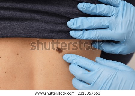 Dermatologist in rubber gloves examining patient's birthmark, closeup view