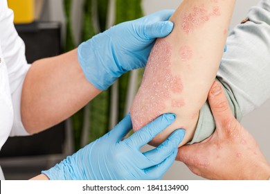 A Dermatologist Wearing Gloves Examines The Skin Of A Sick Patient. Examination And Diagnosis Of Skin Diseases-allergies, Psoriasis, Eczema, Dermatitis.