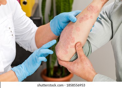 A Dermatologist Wearing Gloves Examines The Skin Of A Sick Patient. Examination And Diagnosis Of Skin Diseases-allergies, Psoriasis, Eczema, Dermatitis.