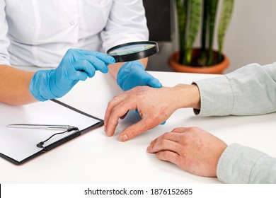 A Dermatologist Wearing Gloves Examines The Skin Of A Sick Patient. Examination And Diagnosis Of Skin Diseases-allergies, Psoriasis, Eczema, Dermatitis.