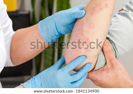 A dermatologist wearing gloves examines the skin of a sick patient. Examination and diagnosis of skin diseases-allergies, psoriasis, eczema, dermatitis.
