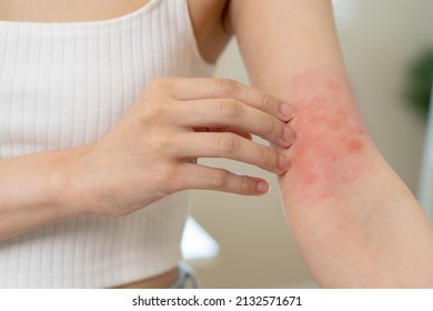 Dermatology, asian young woman, girl hand in her arm allergy, allergic reaction from atopic, insect bites, hand in scratching itchy, itch red spot or rash of skin. Beauty problem by medical treatment. - Shutterstock ID 2132571671