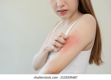 Dermatology, asian young woman, girl hand in her arm allergy, allergic reaction from atopic, insect bites, hand in scratching itchy, itch red spot or rash of skin. Beauty problem by medical treatment.