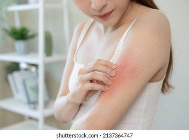 Dermatology, asian young woman, girl allergy, allergic reaction from atopic, insect bites on her arm, hand in scratching itchy, itch red spot or rash of skin. Healthcare, treatment of beauty. - Shutterstock ID 2137364747