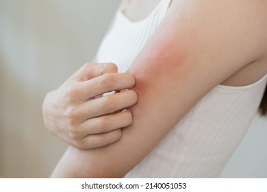 Dermatology, asian young woman, girl allergy, allergic reaction from atopic, insect bites on her arm, hand in scratching itchy, itch red spot or rash of skin. Healthcare, treatment of beauty. - Shutterstock ID 2140051053