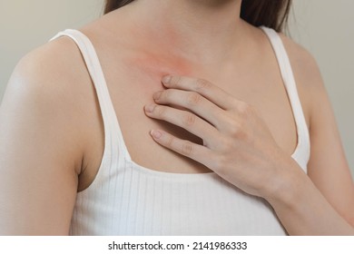 Dermatology, Asian Young Woman, Girl Allergy, Allergic Reaction From Atopic, Insect Bites On Her Body, Hand In Scratching Itchy, Itch Red Spot Or Rash Of Skin. Healthcare, Treatment Of Beauty.