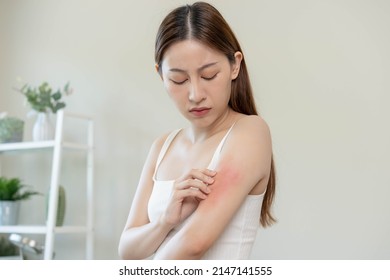 Dermatology, asian young woman, girl allergy, allergic reaction from atopic, insect bites on her arm, hand in scratching itchy, itch red spot or rash of skin. Healthcare, treatment of beauty. - Shutterstock ID 2147141555