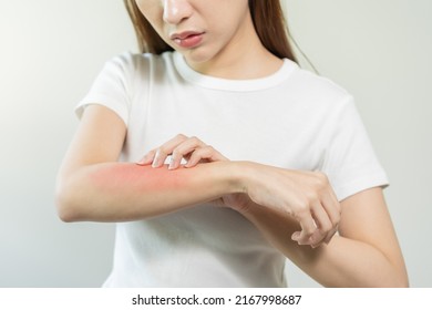 Dermatology asian young woman, girl allergy, allergic reaction from atopic, insect bites on her arm, hand in scratching itchy, itch red spot or rash of skin. Healthcare, treatment of beauty. - Shutterstock ID 2167998687