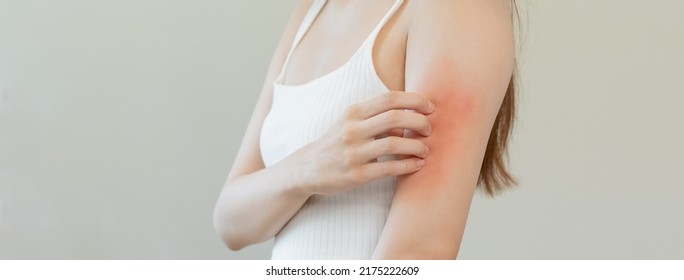 Dermatology, asian young woman, girl allergy, allergic reaction from atopic, insect bites on her arm, hand in scratching itchy, itch red spot or rash of skin. Healthcare, treatment of beauty. - Shutterstock ID 2175222609