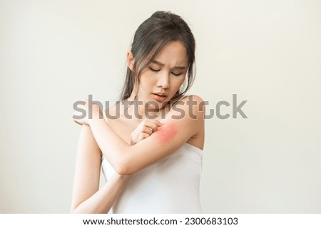 Dermatology asian young woman, girl allergy, allergic reaction from atopic, insect bites on her arm, hand in scratching itchy, itch red spot or rash of skin. Healthcare, treatment of beauty.