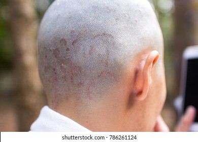 dermatology: Fungus on the scalp, Ring worm, Dry, scaly skin with red edges. Dermatophyte