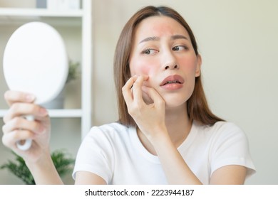 Dermatology, Scratch Asian Young Woman Looking At Mirror, Expression Worry And Itch, Itchy Allergy Or Allergic Sensitive Reaction, Red Spot Or Rash On Her Face. Beauty Care From Skin Problem Treatment