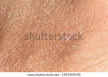 Dermatology and skincare concept with a macro view on the flaking skin of a caucasian person. Detailed view of the cracks and lines filling the frame.