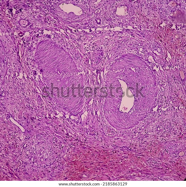 Dermoid Cyst Mature Cystic Teratoma Show Stock Photo 2185863129 ...