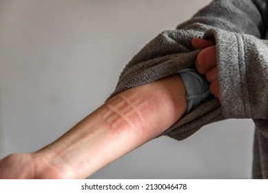 Detail of the arm of a woman suffering from a skin condition called dermographism, dermatographism or "skin writing", a common, bening type of urticaria. - Shutterstock ID 2130046478