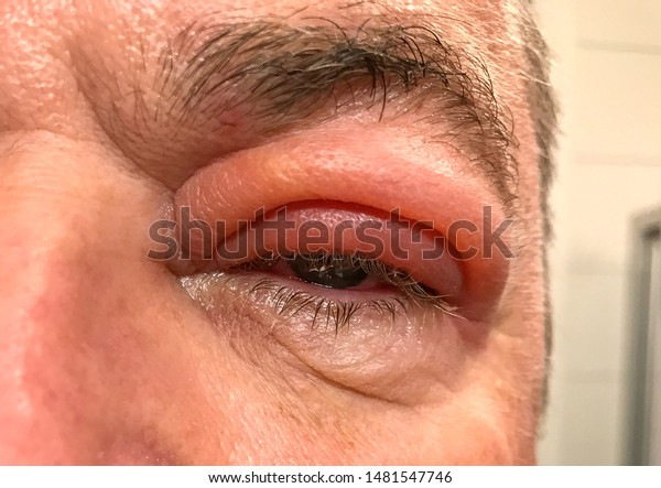 upper eyelid swelling