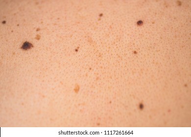 Detail Of The Bare Skin On Man In The Back, Disorders Of Body With Moles On Skin Growths Include Warts 