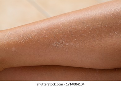 Detail Of Dry Skin Of Woman Legs. Dehydration Due To The Sun's Rays Without Sun Protection Cream