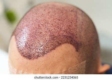 Detail of hair line after hair transplant surgery to cure baldness at clinic - Shutterstock ID 2231234065