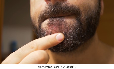 Detail Of The Man's Chin With Seborrheic Dermatitis In The Beard Area. Dry Skin Peels Off And Causes Itching And Dandruff.