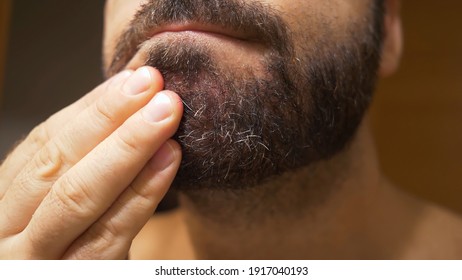 Detail Of The Man's Chin With Seborrheic Dermatitis In The Beard Area. Dry Skin Peels Off And Causes Itching And Dandruff.