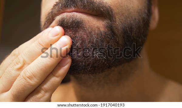Detail of\
the man\'s chin with seborrheic dermatitis in the beard area. Dry\
skin peels off and causes itching and\
dandruff.