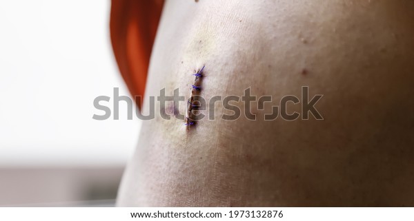 Detail of medical operation, stitches for\
healing, post-operative