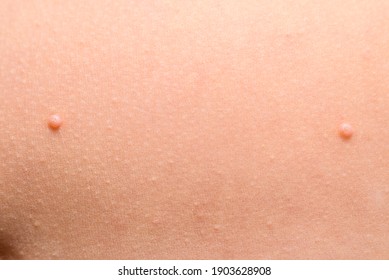 Detail Of A Molluscum Contagiosum Nodule Produced By The Molluscipoxvirus Virus On The Skin Of The Abdomen Of A Child.