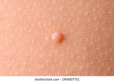 Detail Of A Molluscum Contagiosum Nodule Produced By The Molluscipoxvirus Virus On The Skin Of The Abdomen Of A Child.