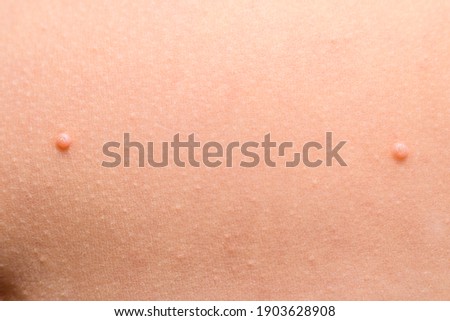 Detail of a molluscum contagiosum nodule produced by the Molluscipoxvirus virus on the skin of the abdomen of a child. Foto stock © 