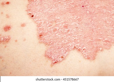 Detail Of Psoriasis Vulgaris, Skin Disease