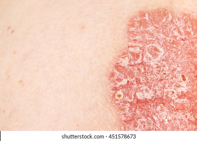 Detail Psoriasis Vulgaris Skin Disease Stock Photo Shutterstock