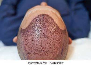 Detail of scalp of male lying down after hair transplant surgery - Shutterstock ID 2231234069