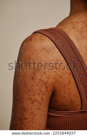 Detail shot of female body focus on skin texture and acne scars on back and shoulders