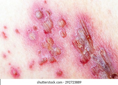 Detail Of Skin With Herpes Zoster (Shingles)