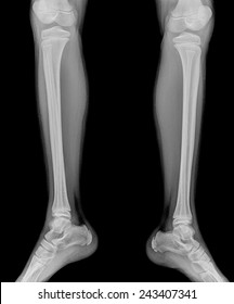Detail of an x-ray of child leg
