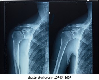 Detail Xray Human Shoulder Bones Stock Photo 1378541687 | Shutterstock