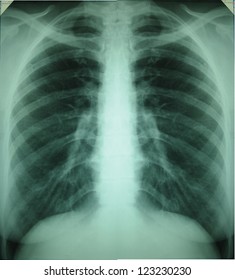 1,000 Normal chest xray Images, Stock Photos & Vectors | Shutterstock