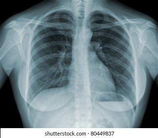 Detail of an x-ray of lungs on black background